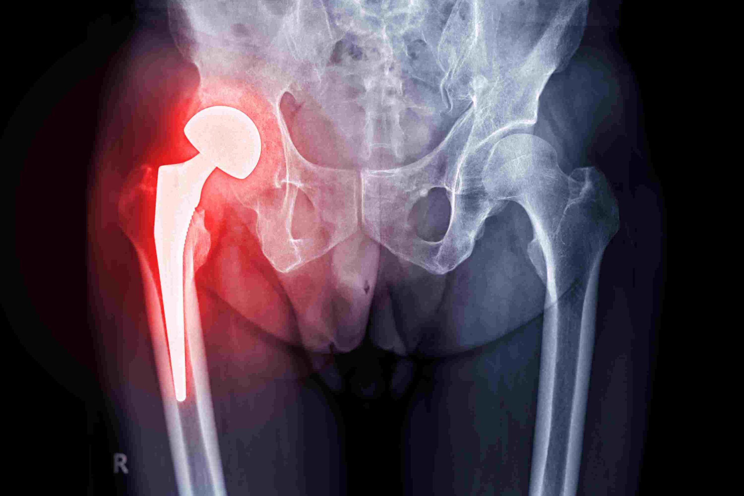 Implantatregister SIRIS Hüfte und Knie_ANQ