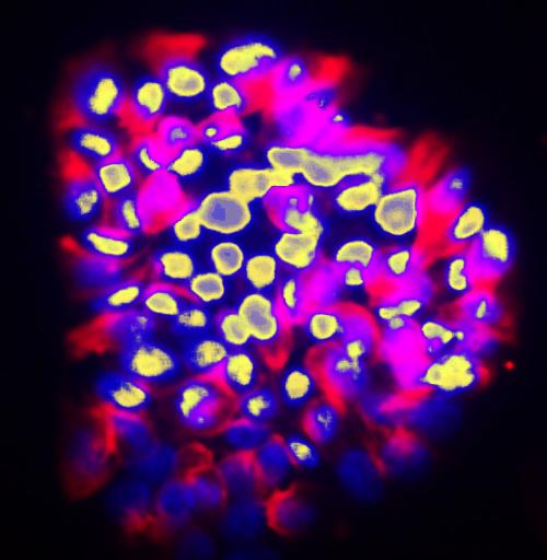Une IA pour prédire le risque de métastases des cancers